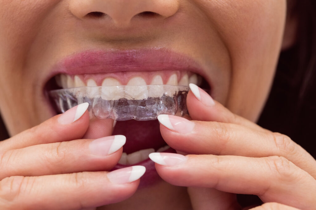 invisalign coral springs