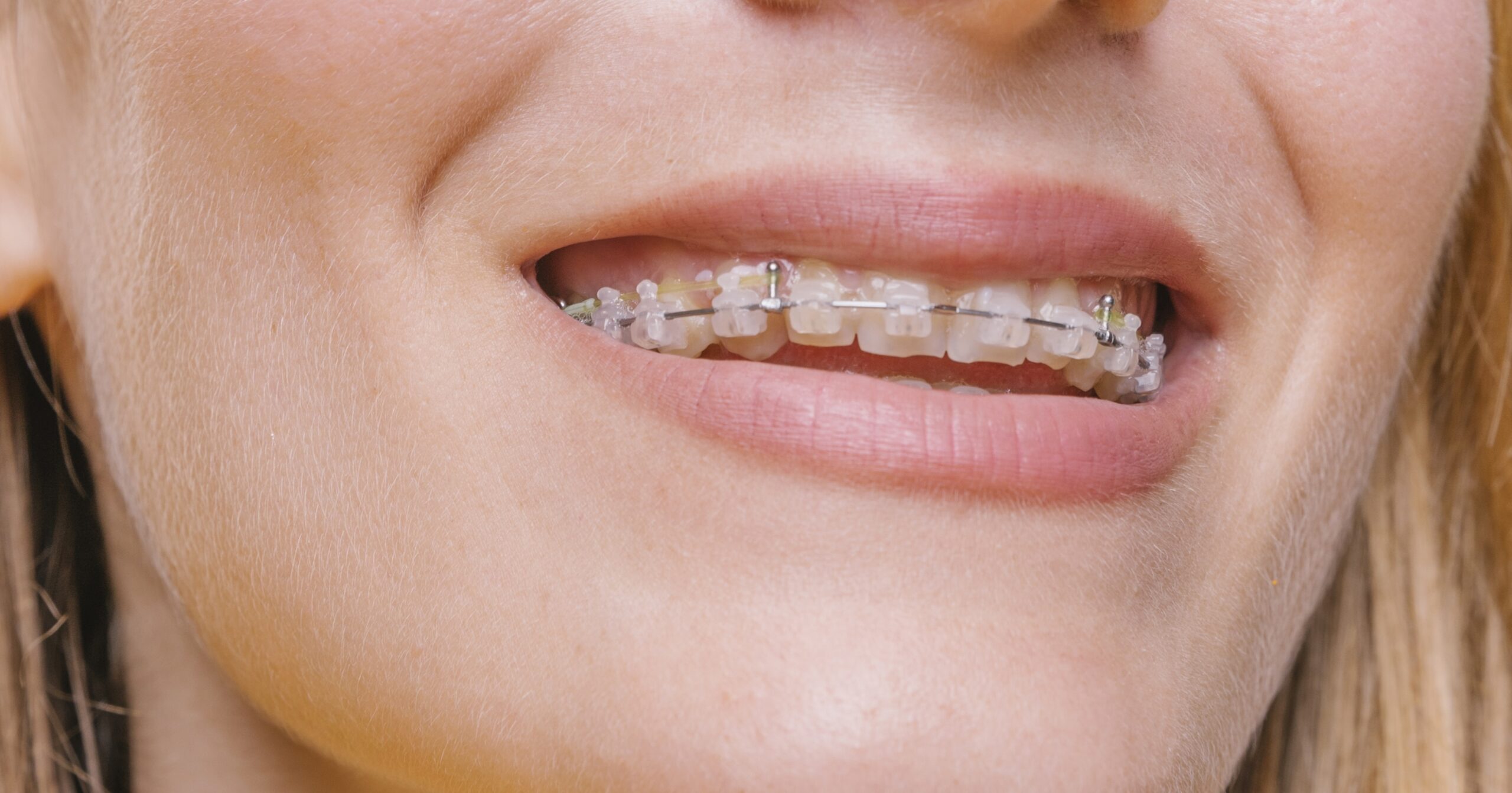 coral springs clear braces