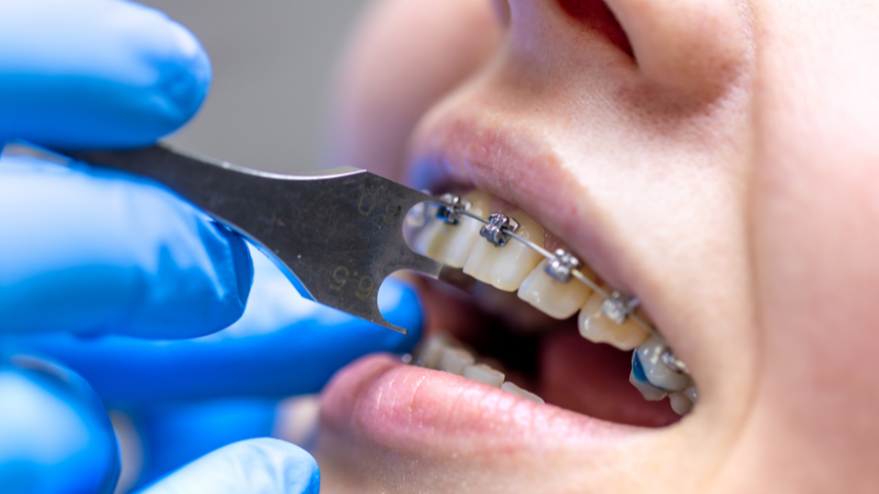 Orthodontic post-treatment care at Freeman Orthodontics in Plantation, showing dental care tools and braces