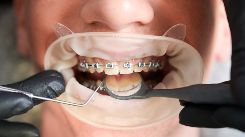 surgical orthodontics in plantation, FL