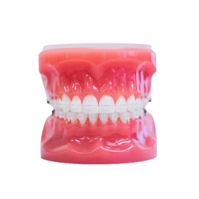 Modern clear braces with tooth-colored brackets at Freeman Orthodontics in Fort Lauderdale