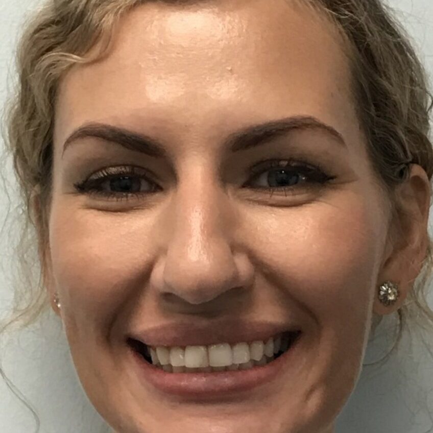 Close-up of a woman with a bright, confident smile showing off her straightened teeth after orthodontic treatment.